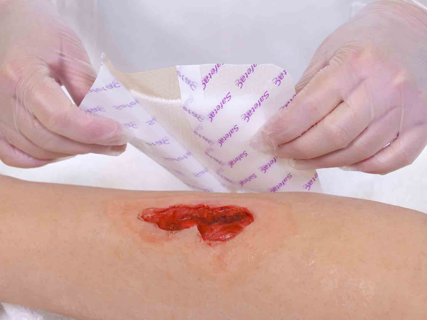 Wound application remove backfilm